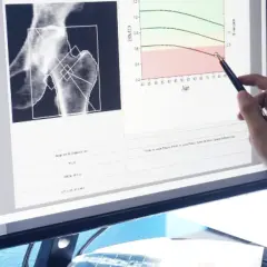 Die entscheidenden Schritte zur Osteoporose Diagnostik verstehen