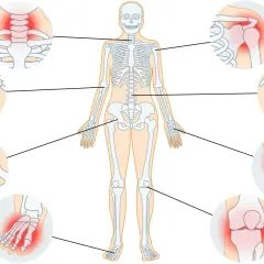 Menschliches Skelett mit hervorgehobenen Gelenken, die Schmerzen zeigen. Arthrose heilen ist so einfach, wenn man die betroffenen Stellen kennt.