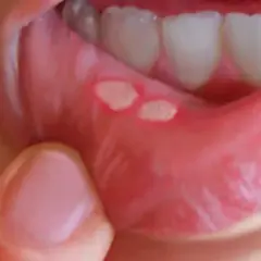Afta a dentysta: Przełożyć wizytę czy iść? Jasne wskazówki.