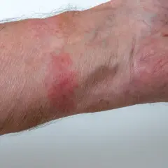 Pelle arrossata e irritata sul polso, sintomo di dermatite da contatto. Quanto dura? Dipende dalla causa.