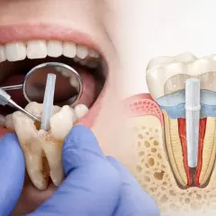 Odbudowa zęba na włóknie szklanym. Dentysta umieszcza wkład w korzeniu zęba, przygotowując go do odbudowy.