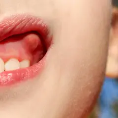 Primer plano de una boca infantil mostrando un bulto en la encía, cerca de los dientes frontales.