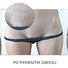Depilacja laserowa bikini: przewodnik krok po kroku i efekty