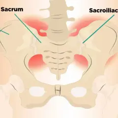 Ilustracja kości miednicy z zaznaczonym stawem krzyżowo biodrowym i obszarami bólu.
