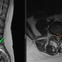 MRI kręgosłupa lędźwiowego z widoczną przepukliną krążka międzykręgowego, zaznaczoną zieloną strzałką. Widoczny pomiar 1.31 cm.