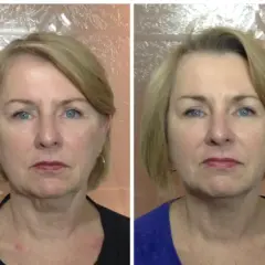 Przed i po zabiegu: zmniejszenie obrzęku limfatycznego twarzy, poprawa konturu szyi.