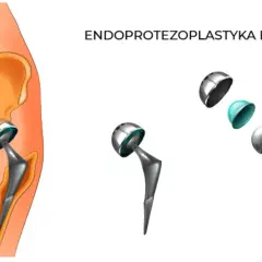 Schemat endoprotezy stawu biodrowego: implant w kości miednicy i kości udowej, oraz rozłożone elementy endoprotezy.