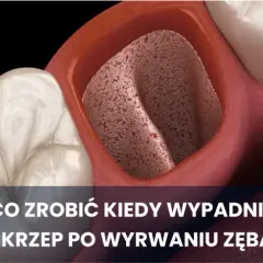 Antybiotyk po ekstrakcji zęba: Kiedy TAK, a kiedy NIE?