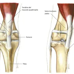 Illustrazione anatomica del ginocchio di un cane, che mostra la rotula in posizione normale e una lussazione mediale della rotula, con rotazione interna della tibia.