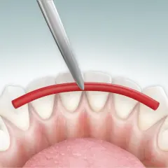Strumento dentale applica filo rosso per splintaggio denti inferiori, facilitando la pulizia.