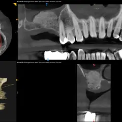 Immagini TC dentali che mostrano un rialzo seno mascellare prima e dopo, con innesto osseo e impianto dentale.