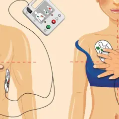 Instrukcja użycia AED: jak podłączyć elektrody do klatki piersiowej mężczyzny i kobiety, by ratować życie.