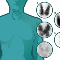 Imágenes de gammagrafía tiroidea que muestran la función de la glándula tiroides. El yodo para que sirve es fundamental para la producción de hormonas tiroideas.