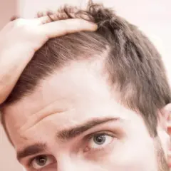 Hombre preocupado por el efluvio telógeno, tocando su cabeza. Considera usar minoxidil para recuperar su cabello.