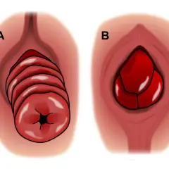 Illustration A montre une descente d'organes chez l'homme avec des plis distincts. Illustration B montre une masse rouge, possiblement une hernie.
