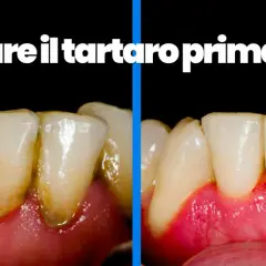 Denti con tartaro visibile prima e dopo la pulizia, che mostra un netto miglioramento.