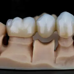 Model szczęki z mostem porcelanowym, imitującym naturalne zęby.