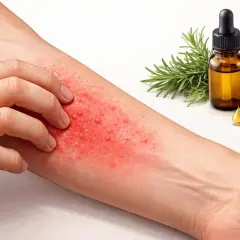 Bras irrité par une éruption cutanée, peut-être une allergie à l'huile de coco. Un flacon d'huile essentielle et des herbes sont à proximité.