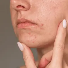 Närbild på munnen och hakan med rodnad och utslag, tecken på perioral dermatit. Solen kan förvärra tillståndet.