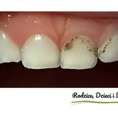 Zbliżenie na zęby dziecka z widocznymi przebarwieniami, które mogą wskazywać na próchnicę. Czarne zęby u dzieci to sygnał do wizyty u dentysty.