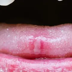 Nahaufnahme einer Zunge mit einer schmerzhaften Wunde, die auf einen Herpes zunge hindeutet. Die Lippen sind gerötet und gereizt.