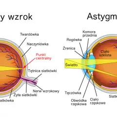 Porównanie oka z astygmatyzmem i normalnym wzrokiem. Astygmatyzm objawy: światło rozprasza się na siatkówce, zamiast skupiać w jednym punkcie.