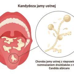 Ilustracja przedstawia jamę ustną z białymi nalotami na języku i podniebieniu, co jest objawem kandydozy jamy ustnej. Obok powiększony obraz drożdżaków Candida albicans.