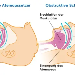 Vergleich: normaler Luftstrom vs. obstruktive Schlafapnoe mit Atemwegseinengung. Dies kann zu Herzrasen führen.