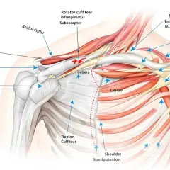 Anatomical illustration of a boxers shoulder, detailing rotator cuff tears, impingement, and labrum injuries.