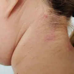 Skóra szyi z zaczerwienieniami i grudkami, które mogą wskazywać na wykrycie boreliozy po kilku latach.