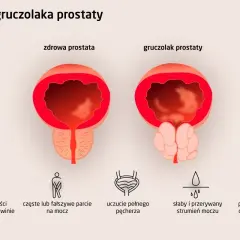 Porównanie zdrowej prostaty i gruczolaka prostaty. Objawy: ból, częste parcie, uczucie pełnego pęcherza, słaby strumień moczu, pieczenie.