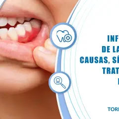 Primer plano de encías inflamadas, mostrando los síntomas de la gingivitis. Información sobre causas y tratamientos.