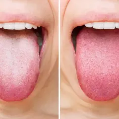 Comparación de lenguas: una muestra la suciedad en la lengua, la otra muestra una lengua limpia y rosada.