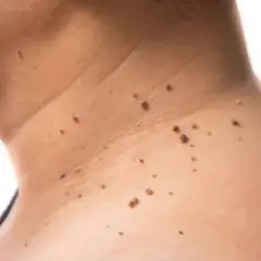 Primer plano de la piel del cuello mostrando varios tipos de manchas, incluyendo lunares y verrugas.