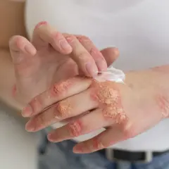 Manos con psoriasis, aplicando crema para aliviar la piel seca y escamosa.