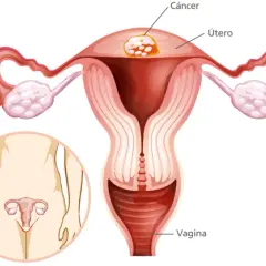 Síntomas de cáncer de útero que no debes ignorar para tu salud