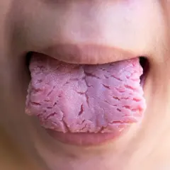 Primer plano de una lengua roja con surcos profundos, asomando entre los labios.