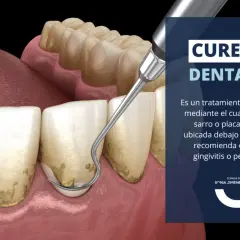Instrumento dental elimina sarro bajo la encía, esencial para la limpieza periodontal y prevenir la periodontitis.