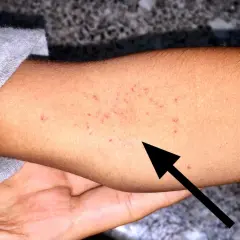 Arm mit roten Punkten, die auf petechien haut hindeuten. Ein schwarzer Pfeil zeigt auf die betroffenen Stellen.