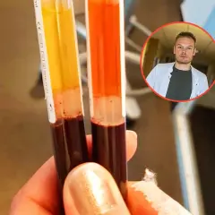 Dwie probówki z krwią, potencjalnie badane pod kątem markerów nowotworowych jelita grubego. W tle lekarz w białym fartuchu.