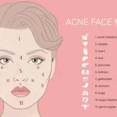 Mappa del viso per l'acne: la zona 3, intorno alla bocca, è collegata agli organi pelvici.