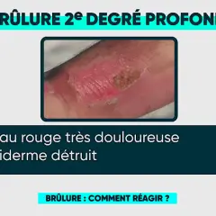 Brûlure 2e degré profond sur la main, peau rouge et douloureuse, épiderme détruit. Une brûlure eau bouillante degré.