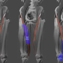 Musculus sartorius: Der Schneider-Muskel, hervorgehoben in Blau, verläuft diagonal über den Oberschenkel.