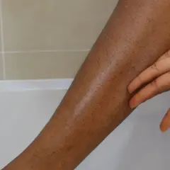 En hand rör vid en ben med mörka prickar, som ger ett utseende av "strawberry legs".