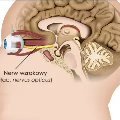 Przekrój głowy ukazujący oko i mózg. Strzałka wskazuje nerw wzrokowy, którego zapalenie może prowadzić do problemów ze wzrokiem.