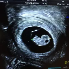 Pierwsze chwile radości, kiedy USG wykryje ciążę. Widać zarodek o długości 1.83 cm, mający 8 tygodni i 2 dni.