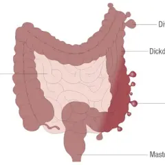 Die wichtigsten Methoden zur Diagnostik von Divertikulose und ihre Risiken