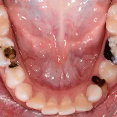Denti da latte con carie evidenti, alcuni con otturazioni scure.