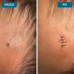 Przed i po zabiegu usuwania pieprzyka z twarzy. Widoczne blizny po chirurgicznym usunięciu zmiany.