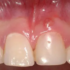 Zapalenie dziąseł u dziecka: Szybka ulga i kiedy do dentysty?